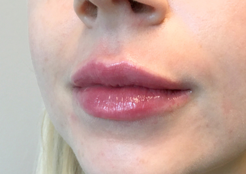 Injectables And Fillers 03