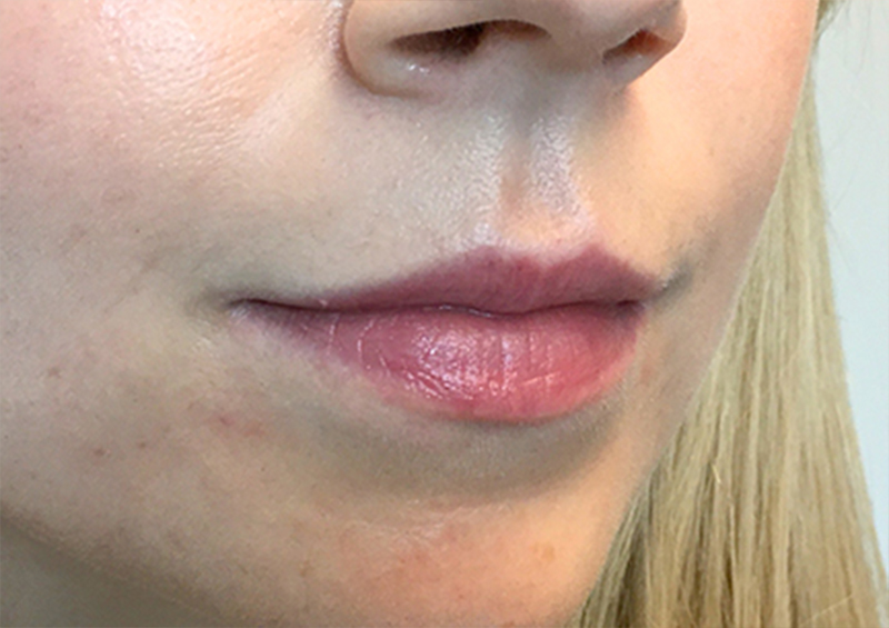 Injectables And Fillers 05