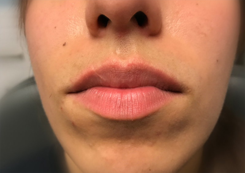 Injectables And Fillers 01