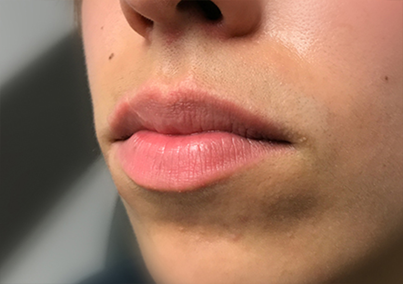 Injectables And Fillers 03