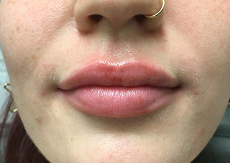 Injectables And Fillers 138