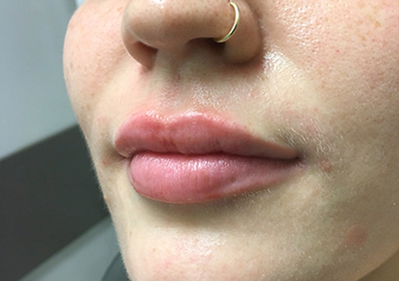 Injectables And Fillers 03