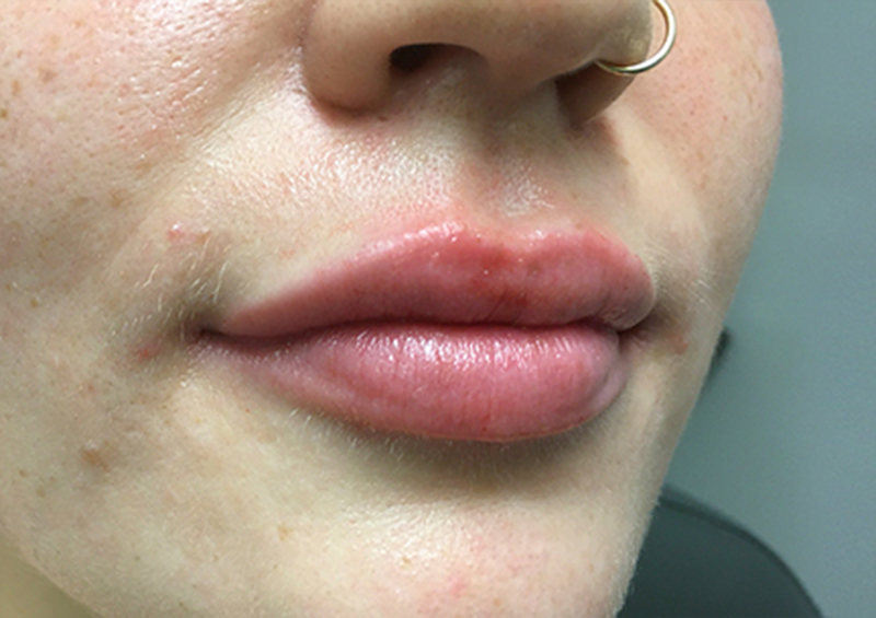 Injectables And Fillers 05