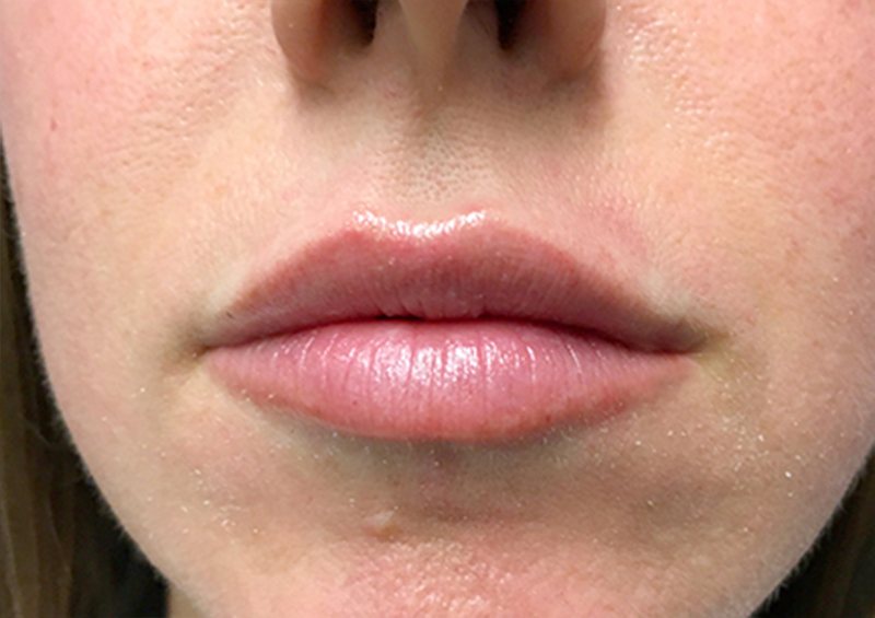 Injectables And Fillers 139