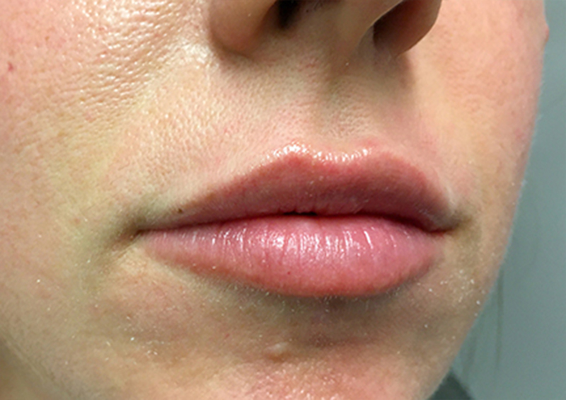 Injectables And Fillers 03