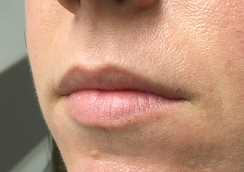 Injectables And Fillers 05