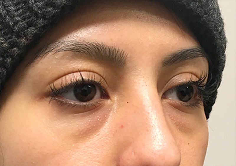 Injectables And Fillers 05