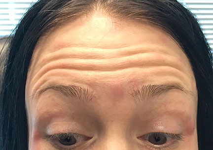 Injectables And Fillers 01