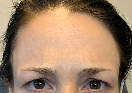 Injectables And Fillers 03