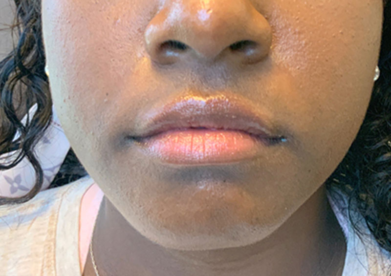 Injectables And Fillers 142