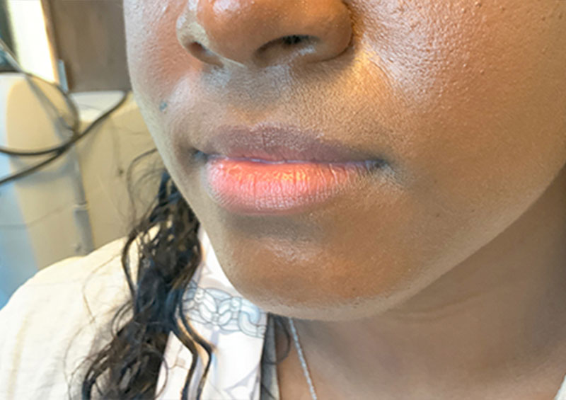 Injectables And Fillers 03