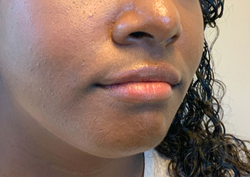 Injectables And Fillers 05