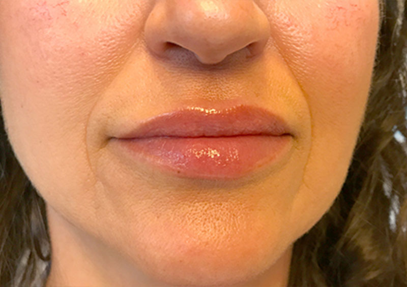 Injectables And Fillers 01