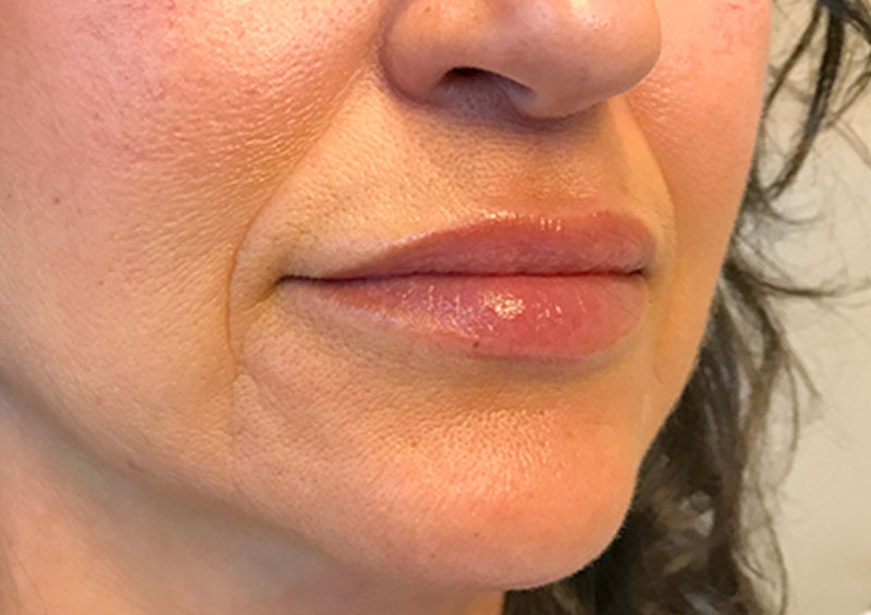 Injectables And Fillers 05