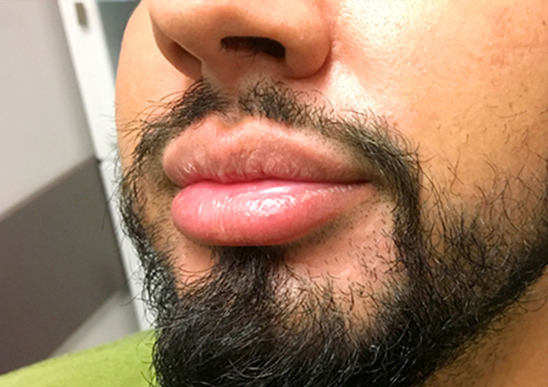 Injectables And Fillers 03