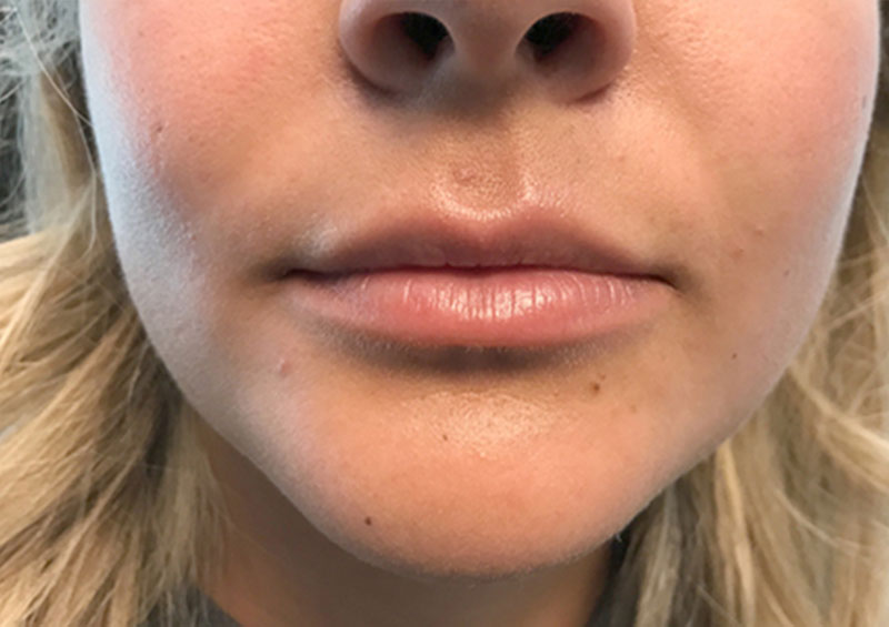 Injectables And Fillers 01