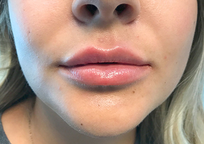 Injectables And Fillers 146