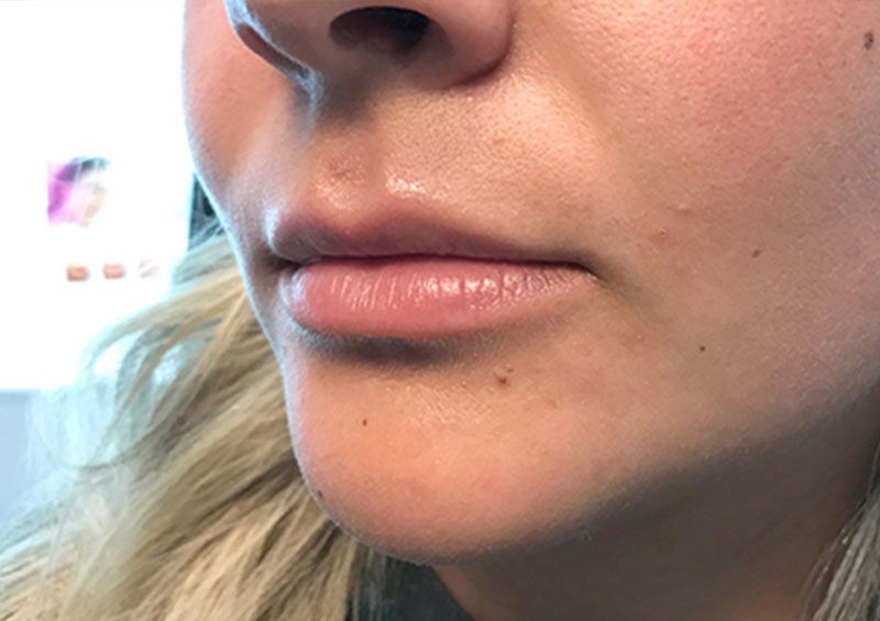 Injectables And Fillers 03