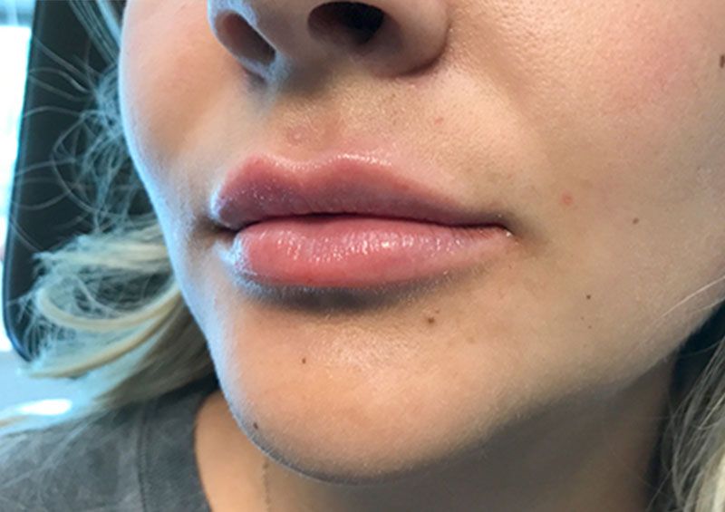 Injectables And Fillers 03