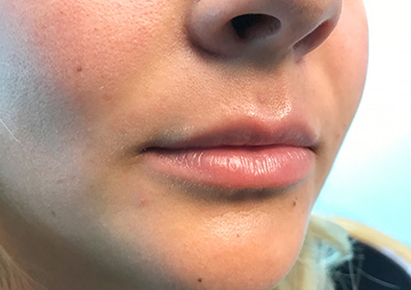 Injectables And Fillers 05