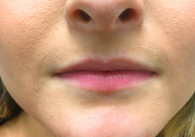 Injectables And Fillers 01