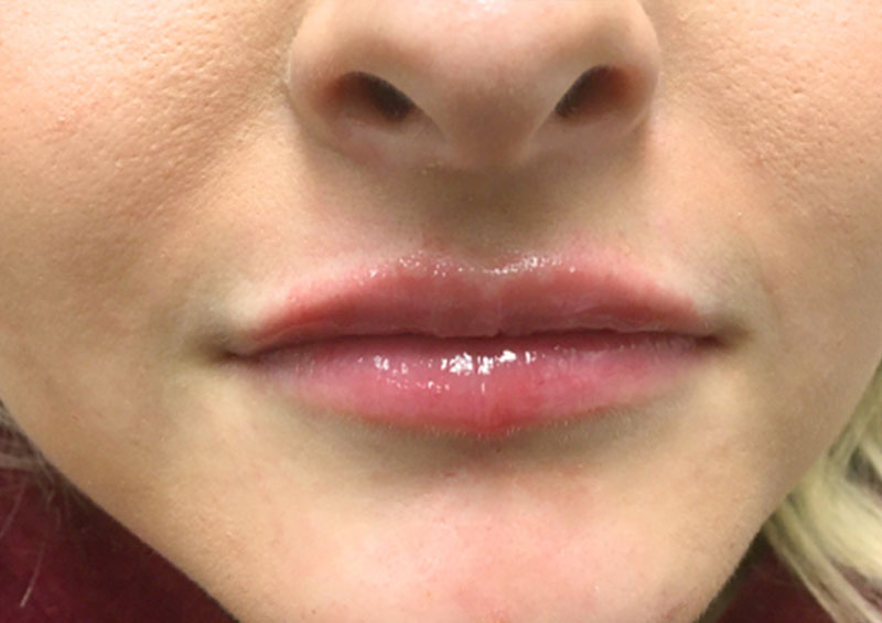 Injectables And Fillers 147