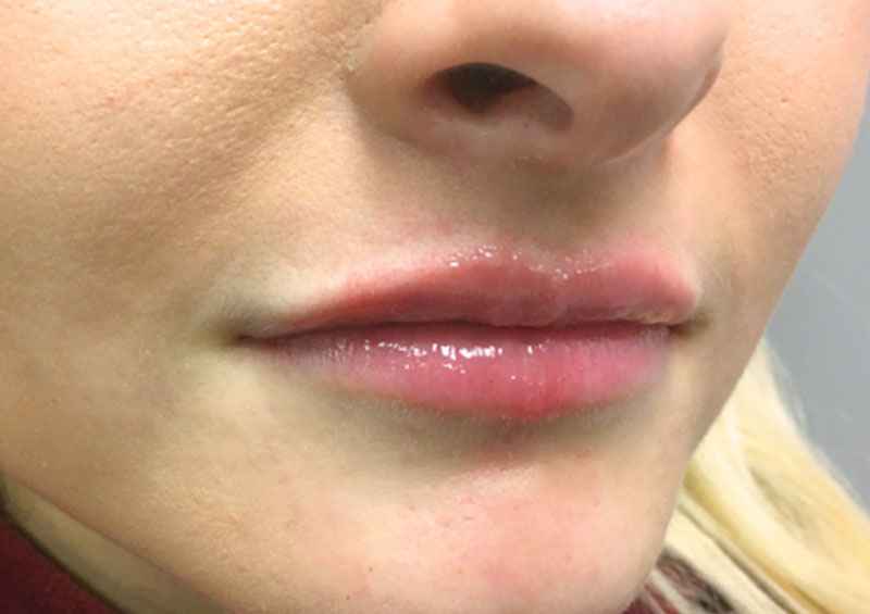 Injectables And Fillers 05