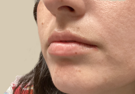 Injectables And Fillers 07