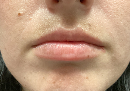 Injectables And Fillers 09