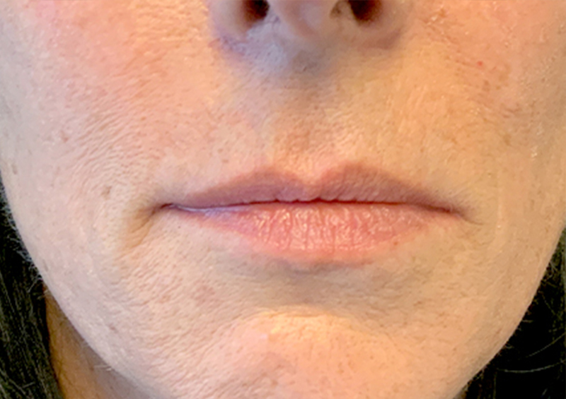 Injectables And Fillers 01