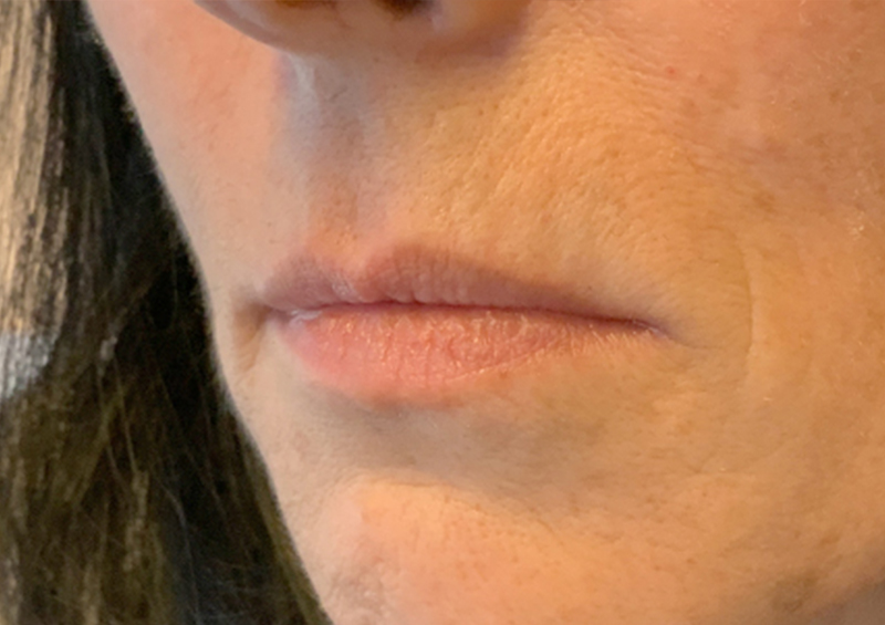 Injectables And Fillers 03