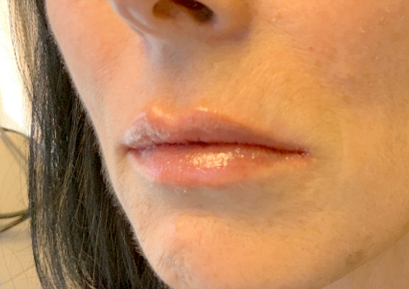 Injectables And Fillers 03