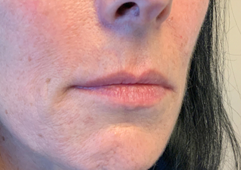 Injectables And Fillers 05