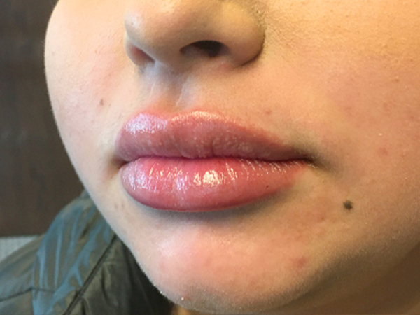 Injectables And Fillers 03