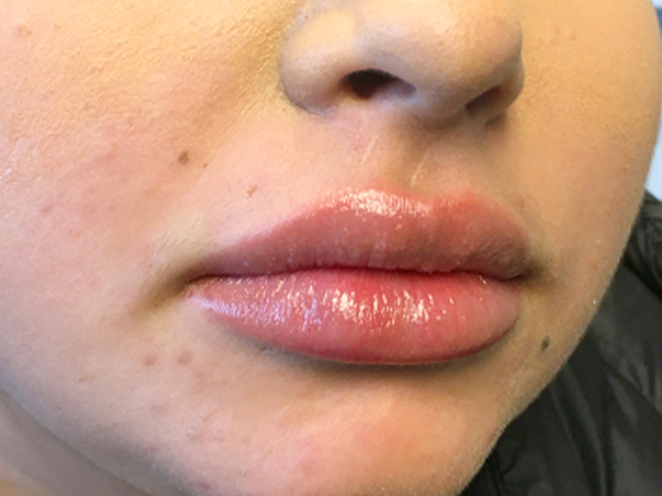 Injectables And Fillers 05