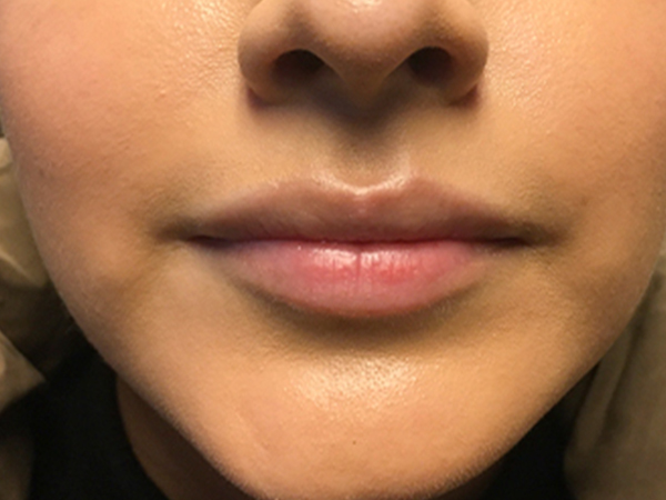 Injectables And Fillers 01