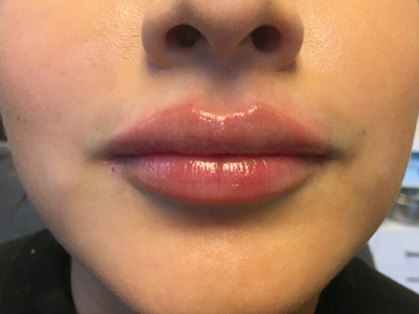 Injectables And Fillers 152