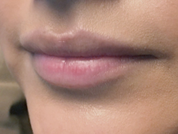 Injectables And Fillers 03