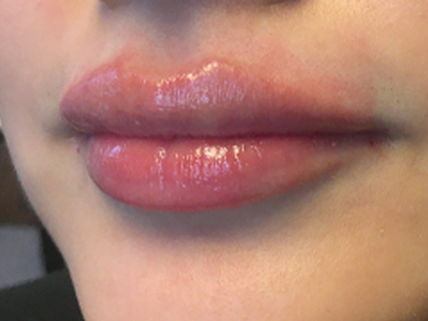 Injectables And Fillers 03