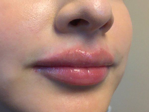 Injectables And Fillers 05