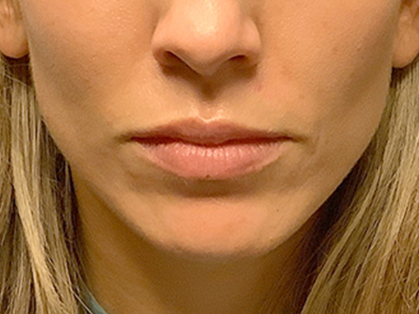 Injectables And Fillers 01