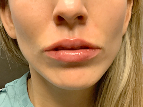 Injectables And Fillers 154