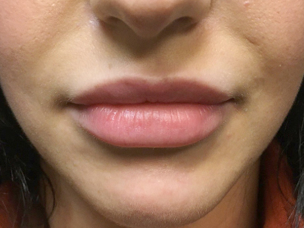 Injectables And Fillers 01