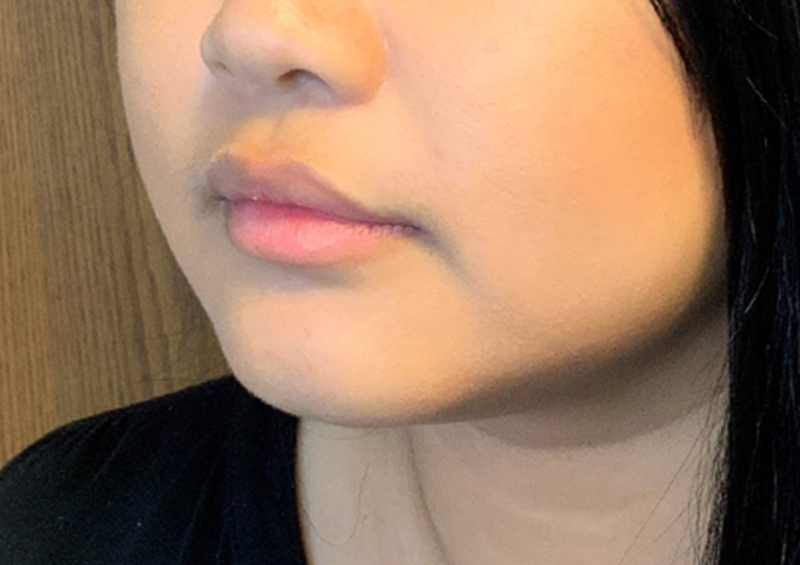 Injectables And Fillers 03