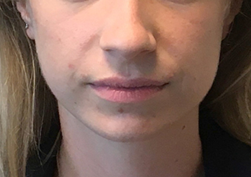 Injectables And Fillers 01