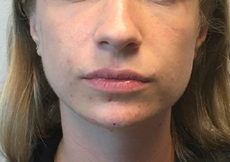 Injectables And Fillers 158