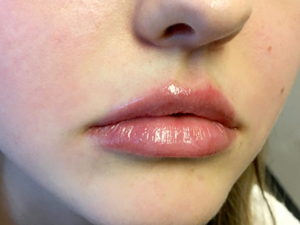 Injectables And Fillers 05