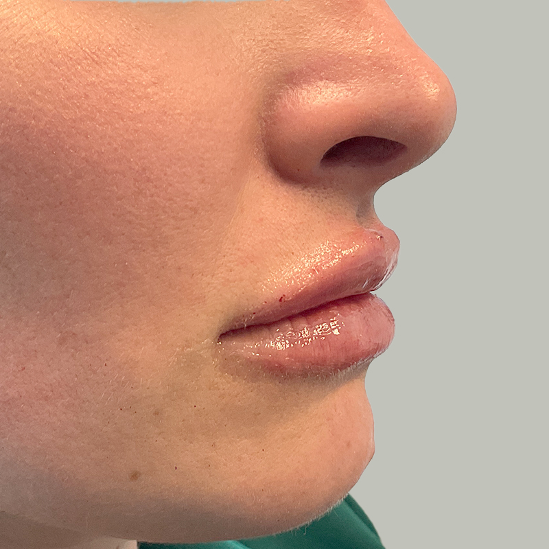 Injectables And Fillers 03