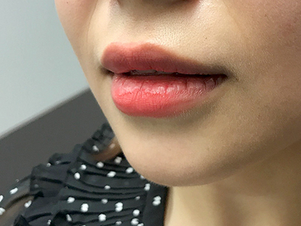 Injectables And Fillers 03