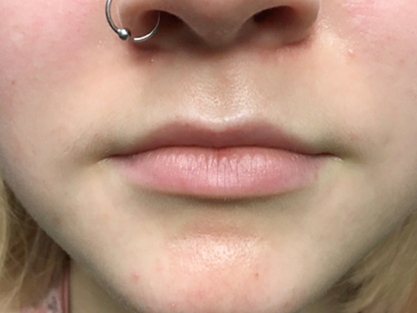 Injectables And Fillers 01